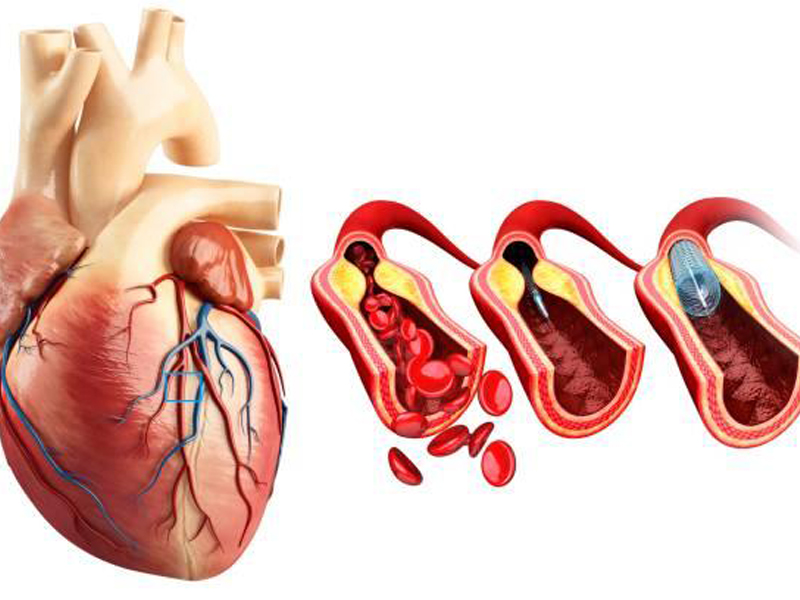 Angioplasty